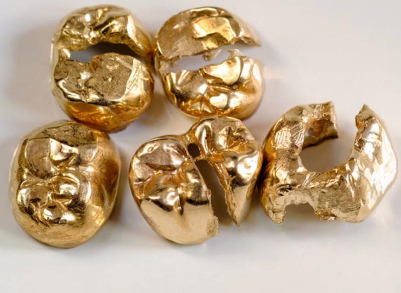 Konvolut aus gereinigten Goldzahn-Kronen und Dentalgold-Legierungen